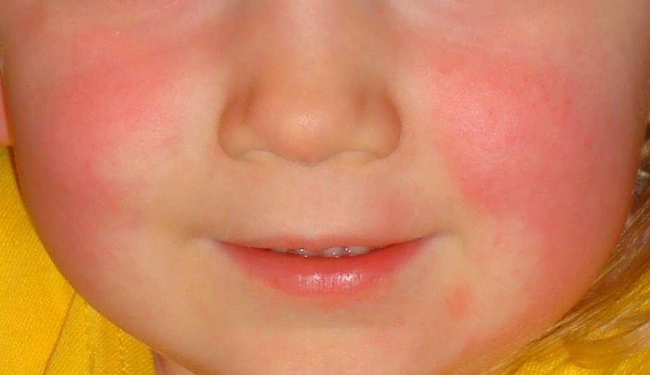 Strep A and Scarlet Fever :: Healthier Together